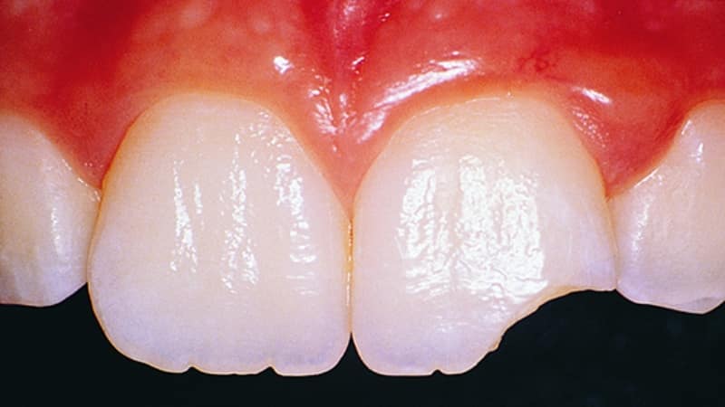 трещины на зубах что делать