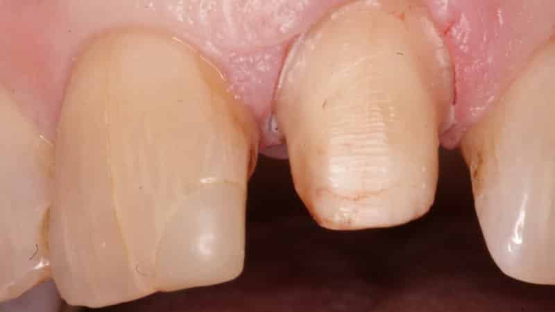 трещины на зубной эмали