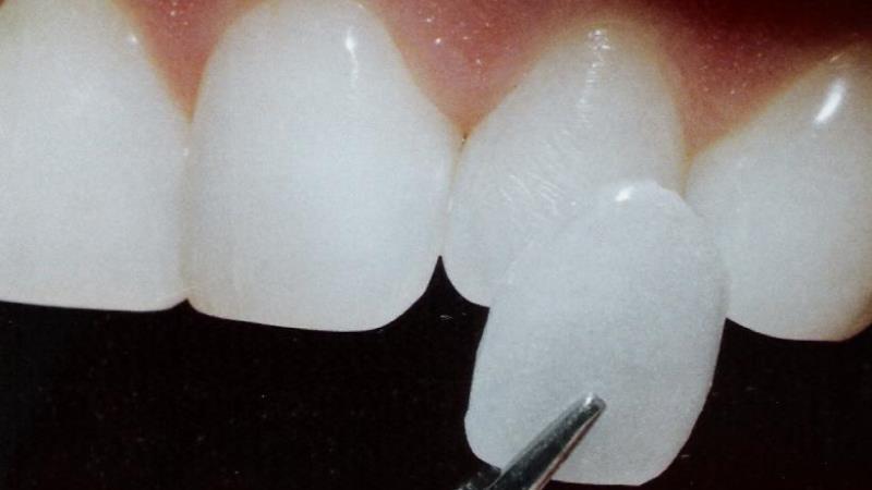 треснула эмаль на переднем зубе