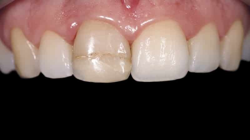 треснула эмаль на переднем зубе