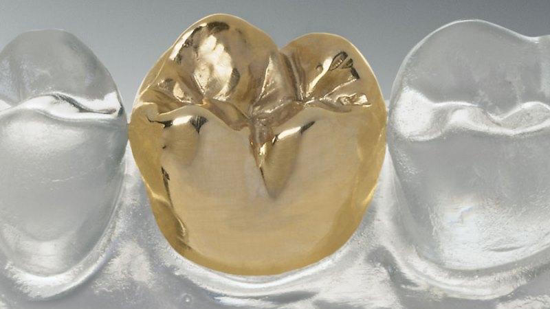 цельнолитые коронки