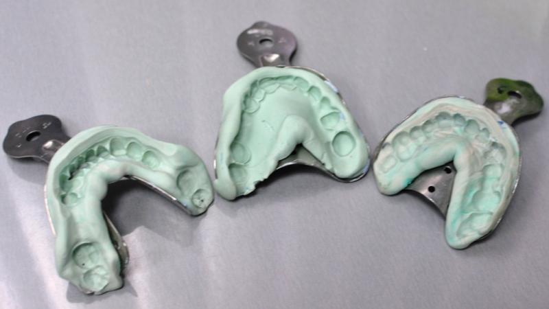 зубные коронки из металла с напылением