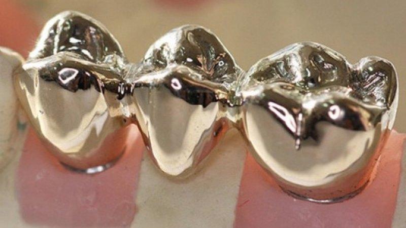 Цельнолитой мостовидный протез