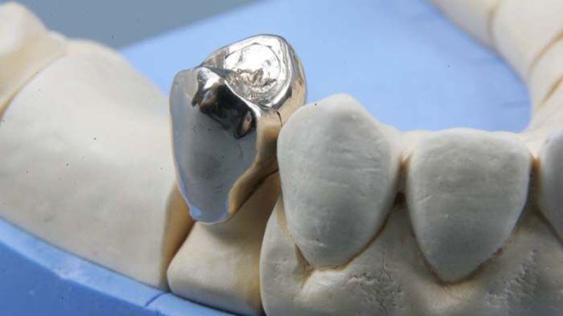 Цельнолитая коронка на задний зуб