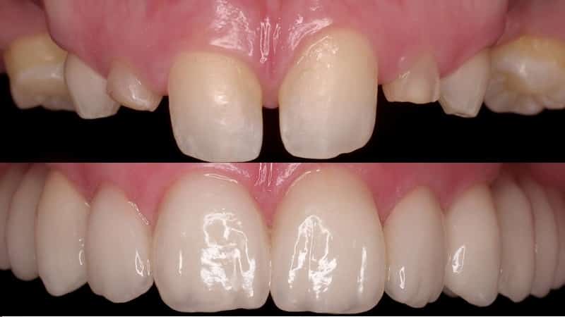 циркониевая коронка фото