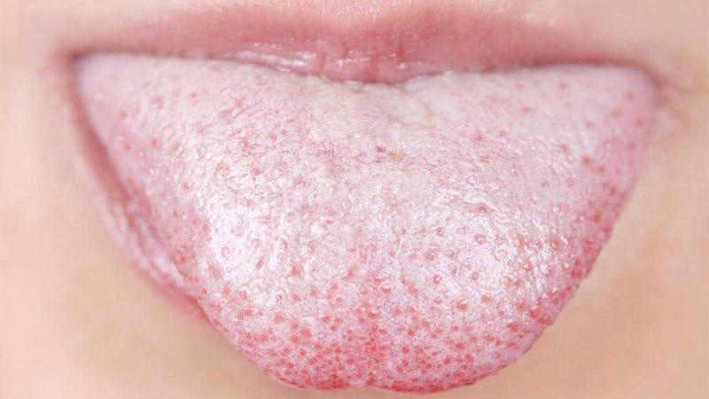 цвет языка и болезни фото