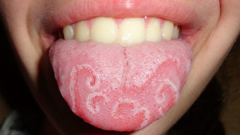 как определить болезнь по языку