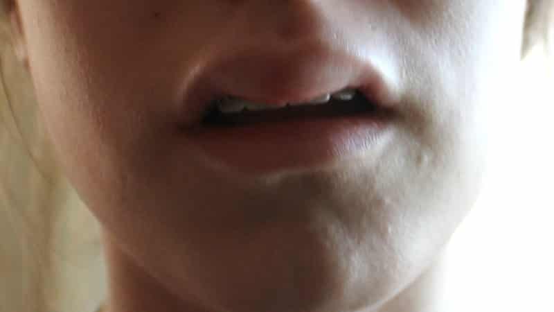 у ребенка опухла верхняя губа причина