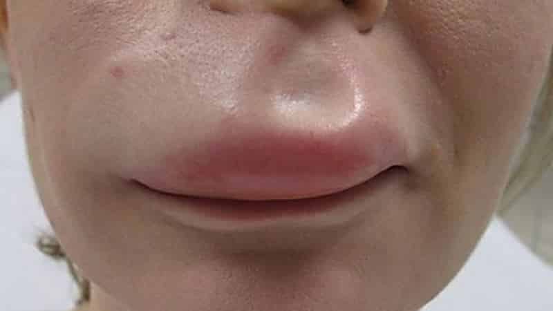 отек губы причины и лечение