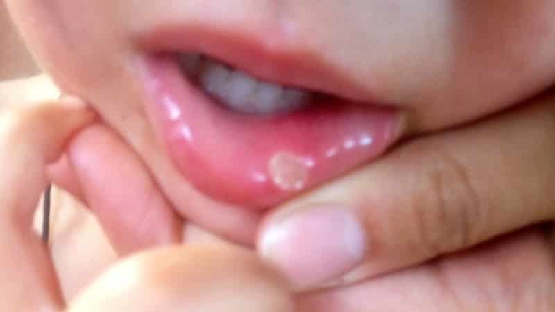 распухла губа от герпеса