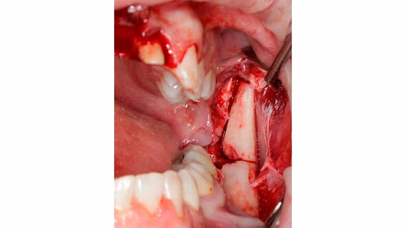 Удаление рединированных и дистопированных зубов
