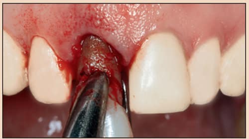 Удаление зуба - Фото 1 Удаление зуба - Фото 1