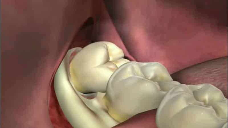 Последствия удаления верхнего 8 зуба