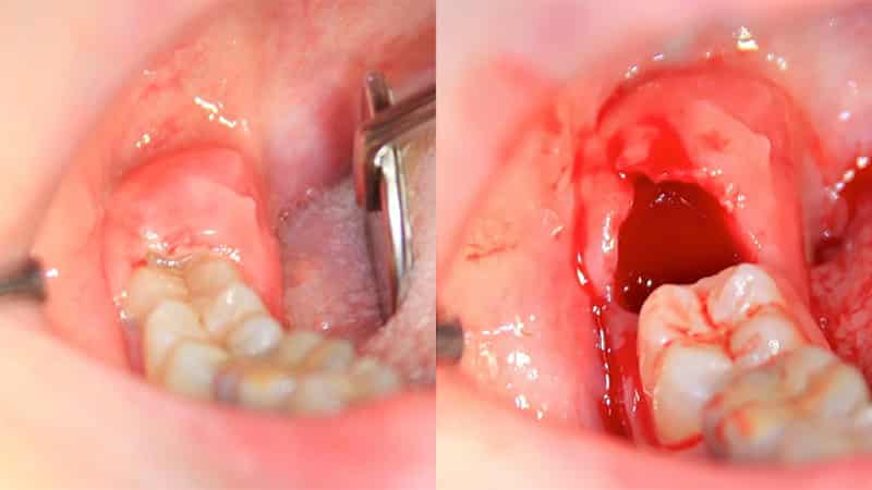 Фото удаления верхнего зуба мудрости