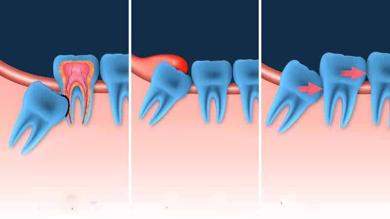 Причины удаления зуба мудрости