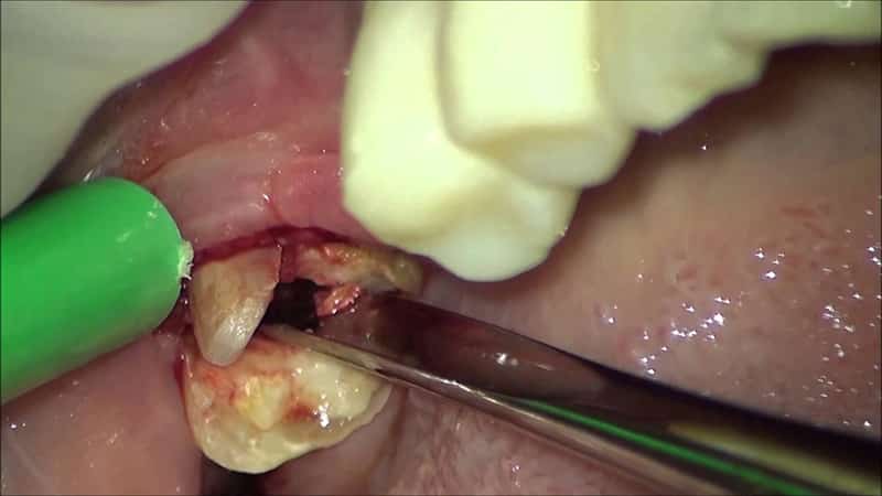 Атипичное удаление зуба мудрости сверху