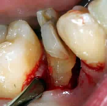 Удаление зуба - Фото 2 Удаление зуба - Фото 2