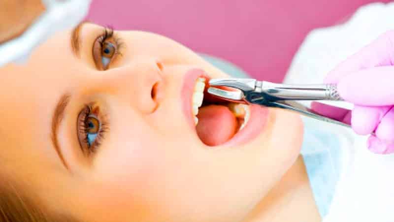 Особенности удаления корней зубов