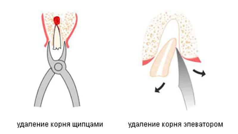 Безболезненное удаление корня зуба