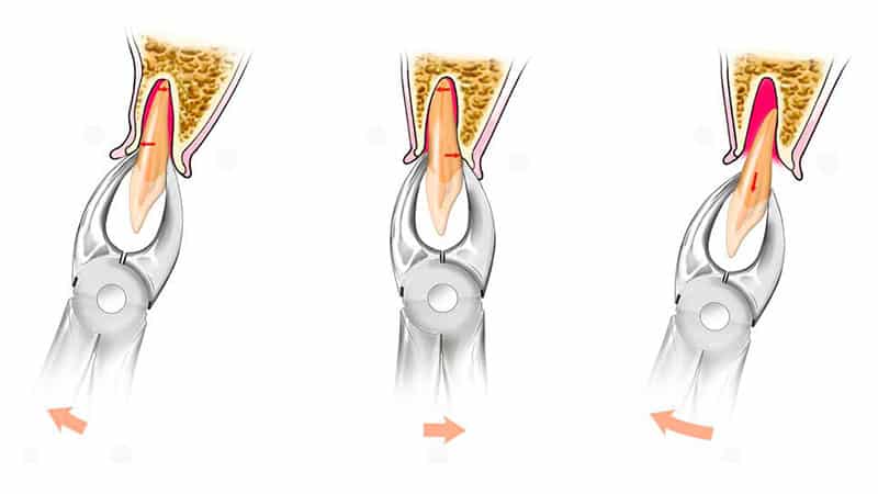 Удаляются корни зуба - фото