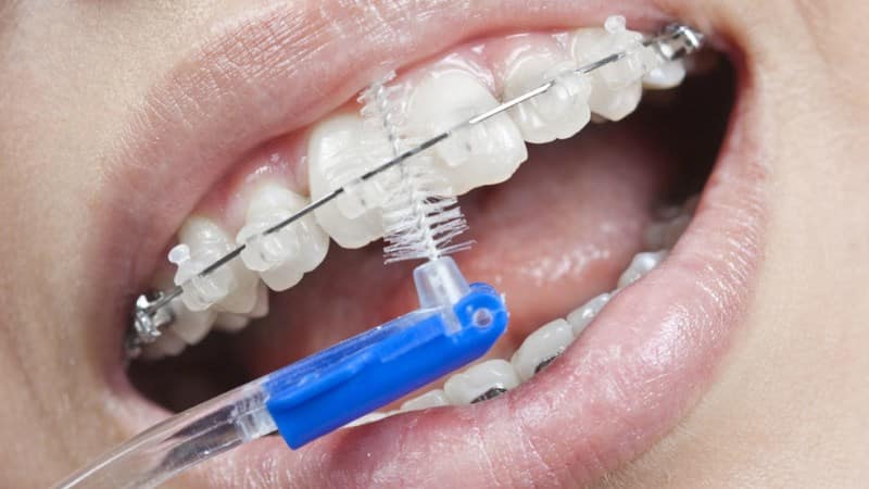 уход за брекетами после установки видео