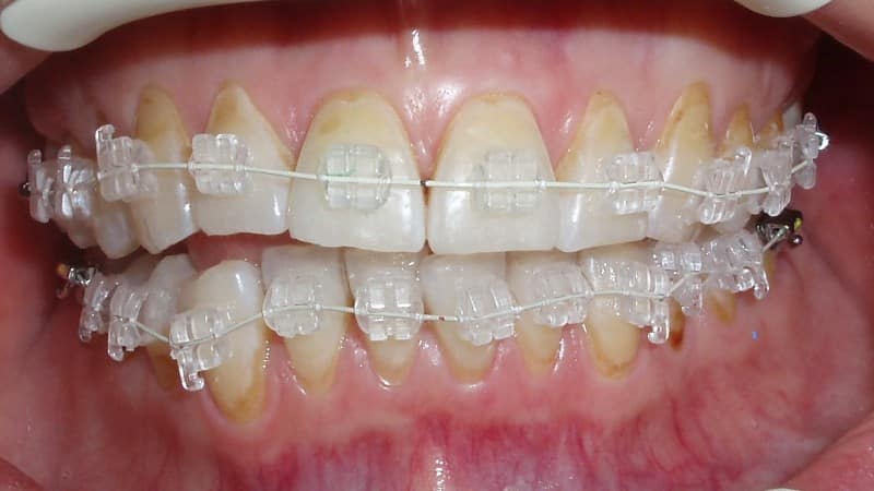 брекеты как ухаживать