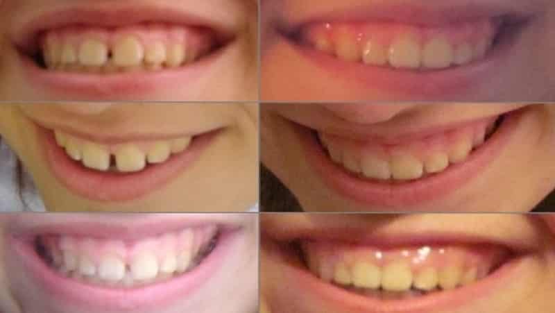 как ставят брекеты фото