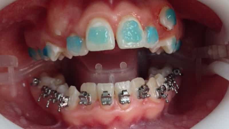 как устанавливают брекеты