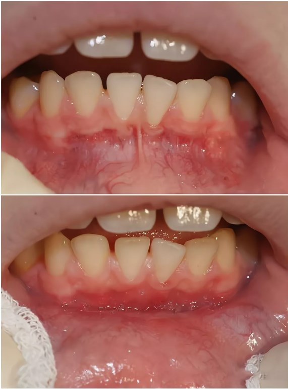 Уздечка нижней губы: пластика у взрослых и детей