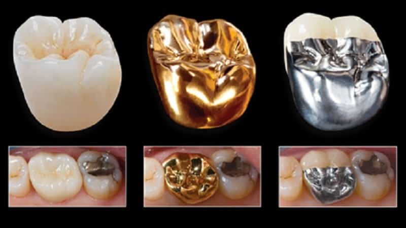 виды коронок для зубов