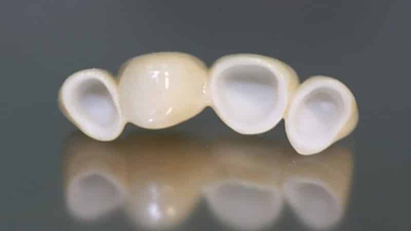 виды коронок на зубы