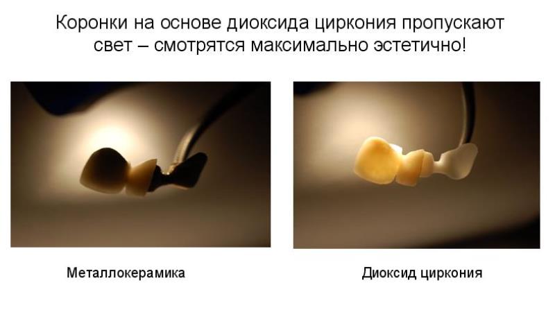 коронки для зубов виды