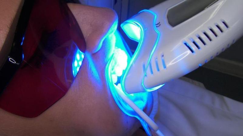 отбеливание зубов виды