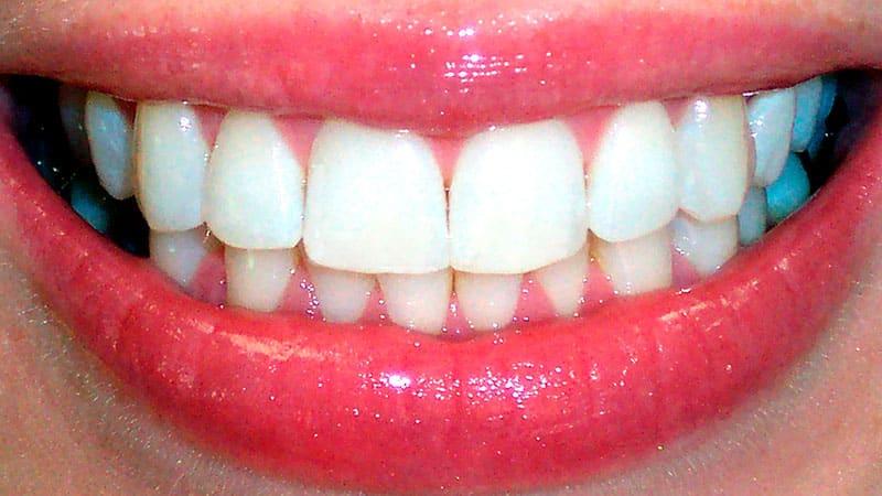 Как выглядит правильный прикус