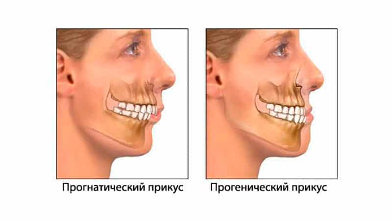 Как выглядит неправильный прикус