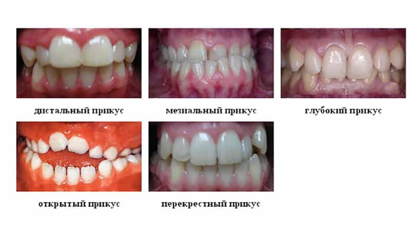 Варианты неправильного прикуса
