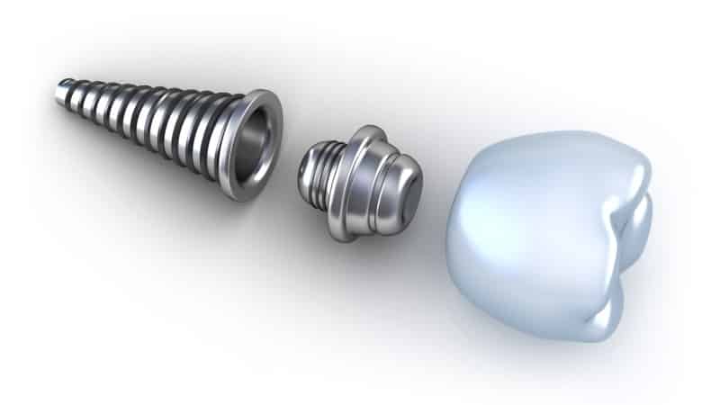 виды зубных протезов и мостов фото