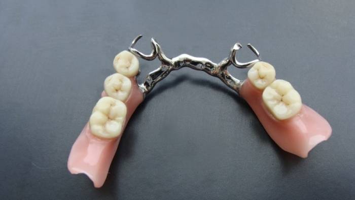 какие виды зубных протезов существуют и их стоимость