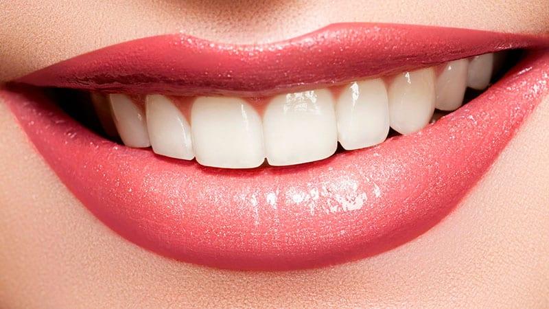 Установка виниров на зубы