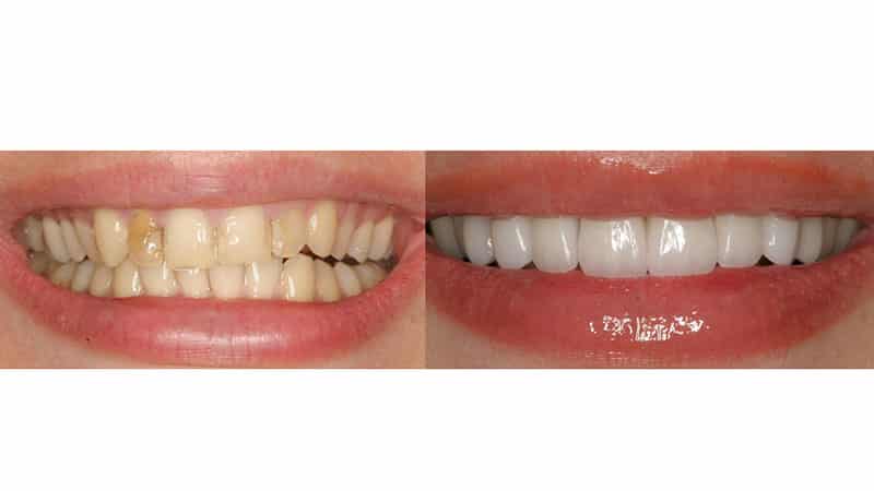 Виниры на зубы - что это такое?