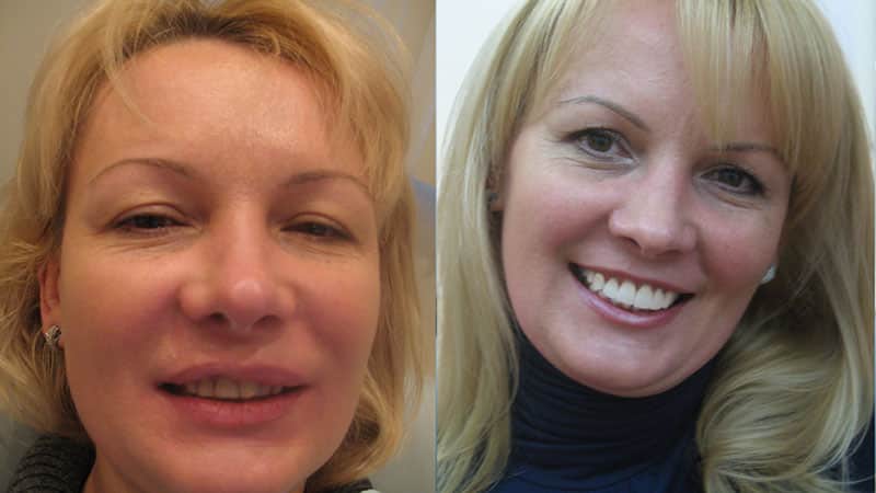 Установка виниров на зубы - фото до и после