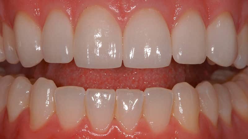 Установленные виниры на зубы