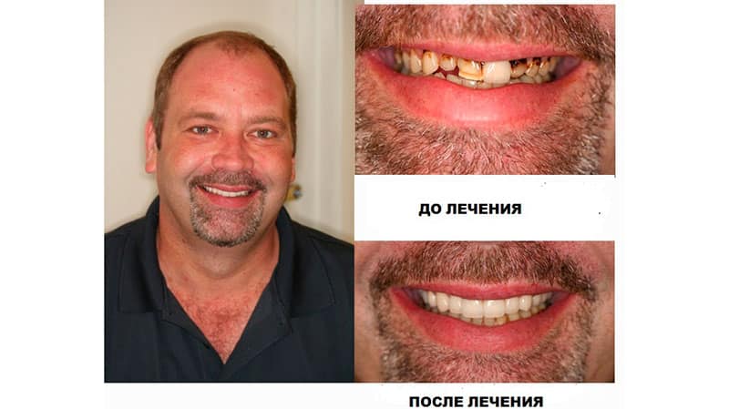 Зубы с винирами