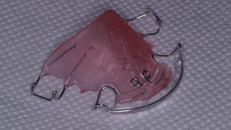 Исправление кривых зубов у детей