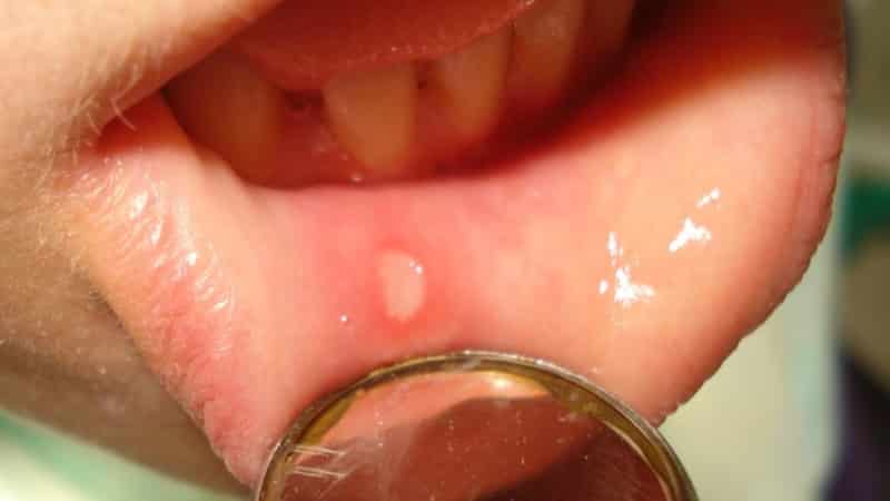 вирусный стоматит у детей симптомы и лечение