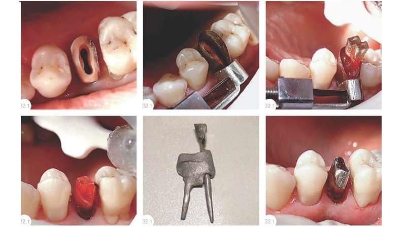 культевая зубная вкладка под коронку что это
