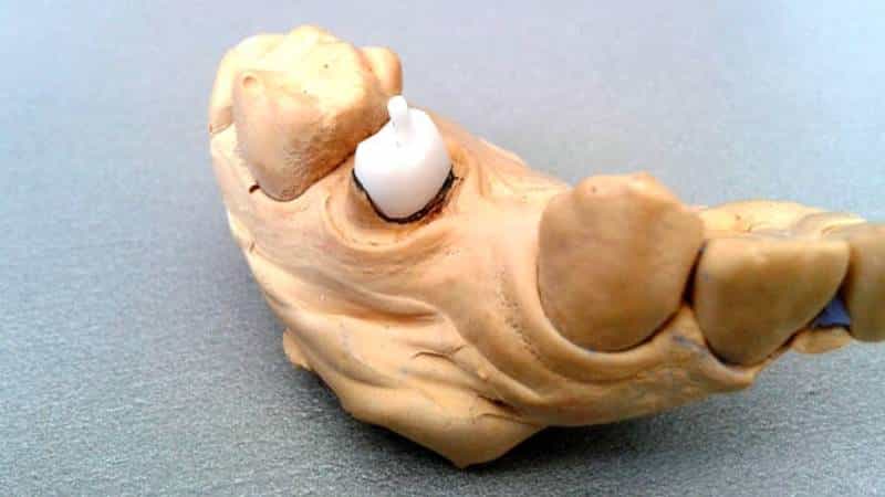 вкладки на зубы что это такое