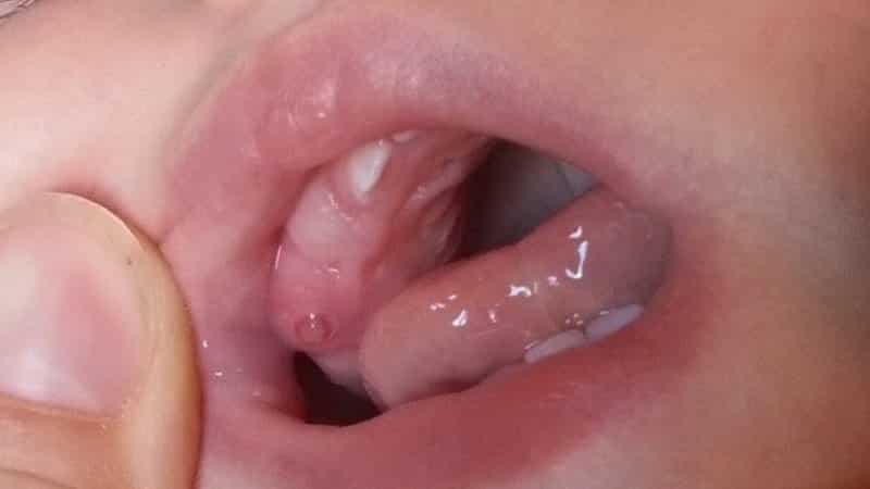 киста на десне у грудничка