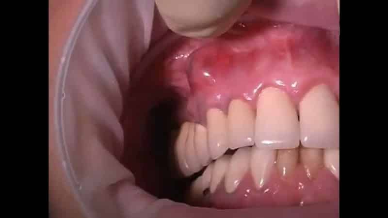 волдырь на десне что это