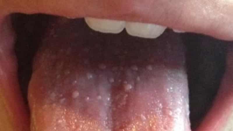 волдыри на языке у ребенка